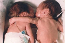 Đặt bé sơ sinh hấp hối nằm cạnh chị sinh đôi... kết quả chấn động