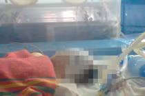 Cháu bé chấn thương sọ não sau khi ở nhà trẻ không phép