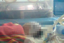 Cháu bé chấn thương sọ não sau khi ở nhà trẻ không phép