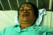 Xót xa những người bị kẻ cuồng yêu tạt axit