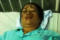 Xót xa những người bị kẻ cuồng yêu tạt axit