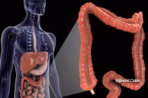 Những điều cần biết về ung thư đại tràng 