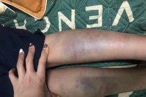  Đà Nẵng: Diễn biến mới vụ học sinh lớp 1 bị đánh bầm tím 