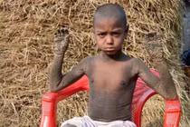 Mắc bệnh da liễu hiếm gặp, cả người cậu bé sắp "hóa đá"