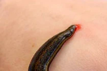 Quảng Nam: Cán bộ thú y gắp con đỉa dài hơn 10cm từ mũi người