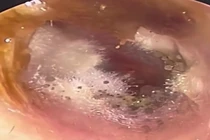 Đau tai đi khám, bác sĩ phát hiện thứ khó tin trong ống tai