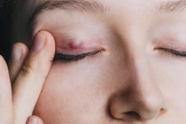 5 nguyên nhân gây ra tình trạng nổi u trên mí mắt