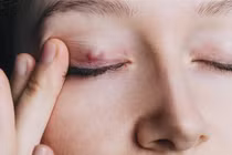 5 nguyên nhân gây ra tình trạng nổi u trên mí mắt