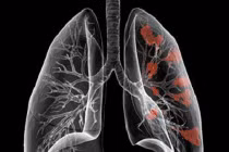 Ung thư phổi do ô nhiễm môi trường tăng cao