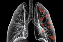 Ung thư phổi do ô nhiễm môi trường tăng cao