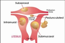 Phân biệt u xơ và ung thư cổ tử cung