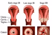 Các biểu hiện thường gặp của bệnh ung thư cổ tử cung