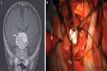 Kỳ lạ răng người xuất hiện trong não trẻ sơ sinh