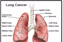 Các loại ung thư phổi thường gặp