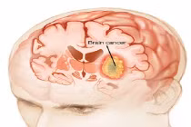 Phân biệt ung thư não với chứng đau đầu thông thường