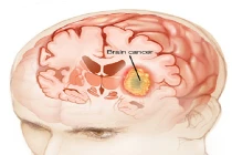 Phân biệt ung thư não với chứng đau đầu thông thường