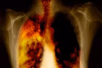 Phân biệt dấu hiệu ung thư phổi và viêm họng thông thường