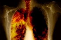 Phân biệt dấu hiệu ung thư phổi và viêm họng thông thường