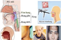 Làm thế nào để phát hiện sớm ung thư vòm họng?
