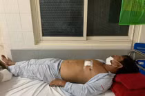 Mâu thuẫn tấc đất, anh trai dùng kéo đâm em nhập viện