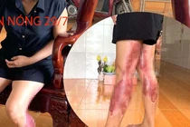 Tin nóng 29/7: Người phụ nữ bị chồng cũ tạt nước sôi