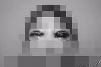 Hot girl mù một mắt, nguy cơ tử vong khi cắt mí tại spa