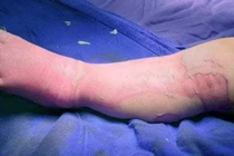 Bé 9 tháng tuổi tử vong do đắp thuốc lá cây chữa bỏng