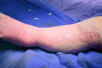 Bé 9 tháng tuổi tử vong do đắp thuốc lá cây chữa bỏng