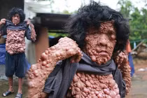 Tâm sự nhói lòng của người đàn ông có hàng ngàn khối u trên người