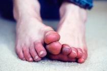 Tay chân lạnh là dấu hiệu nhiều bệnh nguy hiểm