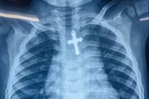 Bé trai 3 tuổi nguy kịch vì nuốt cây thánh giá vào thực quản