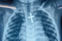 Bé trai 3 tuổi nguy kịch vì nuốt cây thánh giá vào thực quản