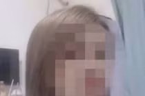 Người phụ nữ mặt trắng bệnh, co giật rồi chết não khi cấy ghép mỡ để làm đẹp