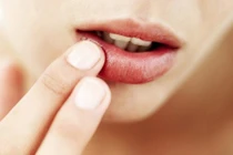 Thấy môi có hiện tượng này, đi khám ung thư miệng ngay kẻo hối hận