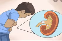 Dấu hiệu cảnh báo người bị hội chứng thận hư