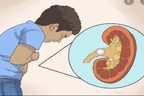 Dấu hiệu cảnh báo người bị hội chứng thận hư