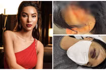 Siêu mẫu Khả Trang tung loạt ảnh bị bạo hành dã man 