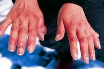 Vì sao giá lạnh quá mức có thể khiến người rụng ngón tay, bò rơi tai?