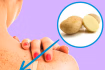 Bật mí tuyệt chiêu loại bỏ các đốm tàn nhang lấm tấm trên da