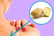 Bật mí tuyệt chiêu loại bỏ các đốm tàn nhang lấm tấm trên da