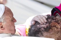 Cảm động giây phút Giáo hoàng ôm bệnh nhân bị u khắp mặt