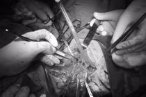 Hy hữu bệnh nhân bị đâm thấu ngực, sát tim được cứu sống