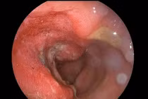 Bệnh ung thư trực tràng nguy hiểm thế nào?