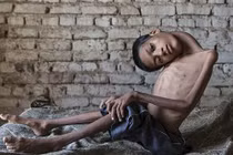 Kỳ lạ cậu bé sống sót dù đầu gãy gập 180 độ