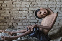 Kỳ lạ cậu bé sống sót dù đầu gãy gập 180 độ