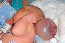 Em bé sinh ra với khối u bóng nước to bằng đầu