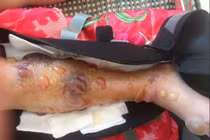 Bác sĩ tắc trách, nữ sinh lớp 10 bị cưa chân