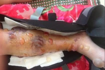 Bác sĩ tắc trách, nữ sinh lớp 10 bị cưa chân