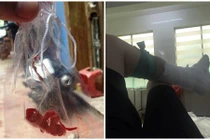 Bệnh nhân tố bác sĩ bỏ quên bông trong vết thương