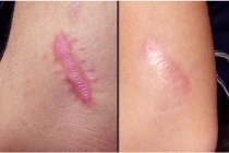 10 thần dược trị sẹo lồi lâu năm 